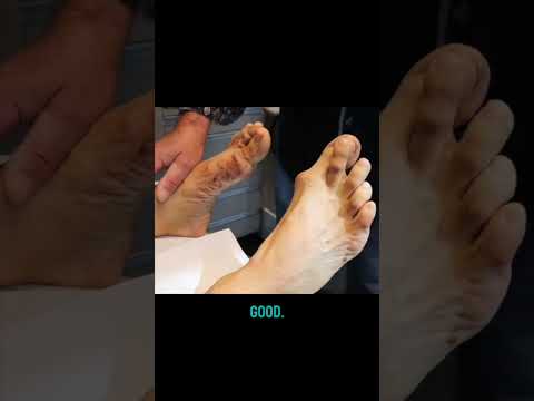 How to correct your bunions #TheBunionKing #Bunions #BunionCorrection #Bunionectomy #Stitch