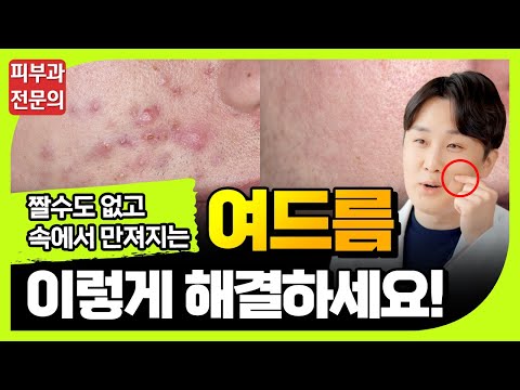 속에서 만져지기만 하고 짤 수 없는 여드름은 이렇게 해결하세요!