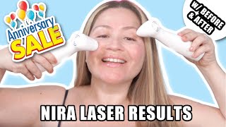 NIRA LASER RESULTS + NIRA ANNIVERSARY SALE 🥳 #niraskin