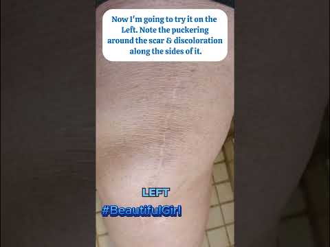 RVLAIM Advanced Silicone Scar Cream Continues to Heal!