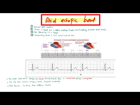 Atrial ectopic beat