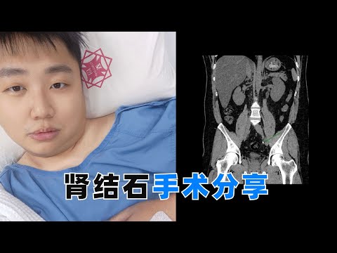 郑斌彦肾结石手术真实经历：肾脏科误区与全身麻醉的感受