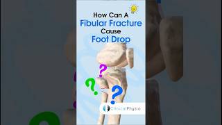 Foot Drop Causes #physicaltherapy #physiotherapy #footdrop #anatomy #fibula #fibulafracture