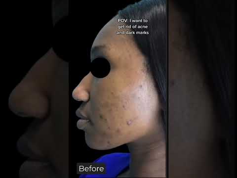 💥Laser for Dark Marks and Acne can safely be done in skin of color!