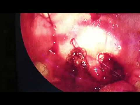 Barbed reposition surgery for sleep apnea