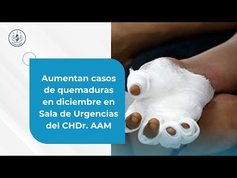 Aumentan casos de quemaduras en diciembre en Sala de Urgencias del CHDr. AAM