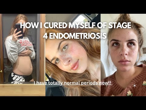 STAGE 4 ENDO SYMPTOMS (+ Life after surgery and how I cured my periods!!)