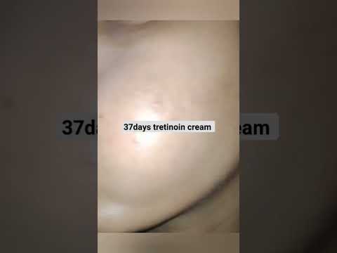 tretinoin cream 0.05 result #acnetreatment #acnescars #acne#pimpal