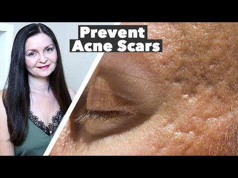 How to Prevent Acne Scars – Tips For Acne Scarring