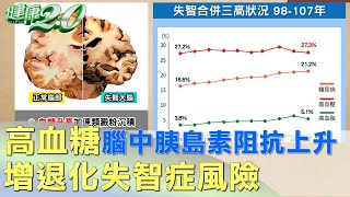 高血糖腦中胰島素阻抗上升 退化失智症風險增 健康2.0