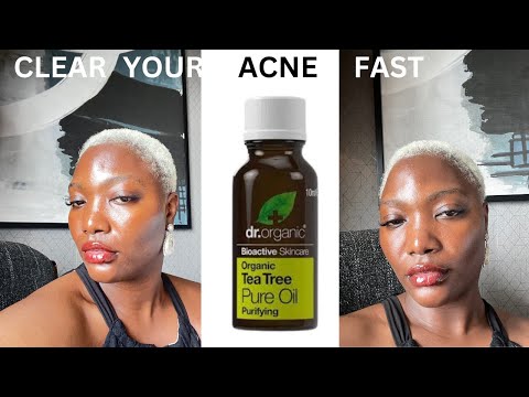 HOW TO CLEAR YOUR ACNE (fast) | tested and trusted #skincaretips101 #clearacne