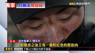 花美男打「蜂巢皮秒」燒燙傷、險毀容 控醫美診所疏失 @newsebc