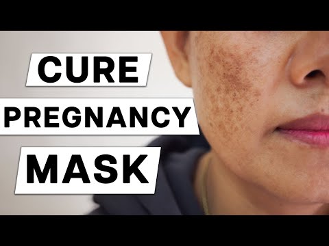 The Best Way to Treat Pregnancy Mask (Melasma) Safely : Doctor Recommends