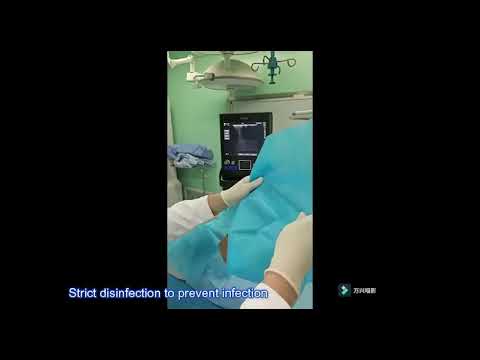 Ultrasound-guided approach for puncturing dorsal root ganglion – Video abstract [479986]