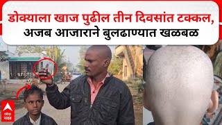 Buldhana Villager Hair Loss : डोक्याला खाज पुढील तीन दिवसांत टक्कल; बुलढाण्यातील शेगावातील घटना