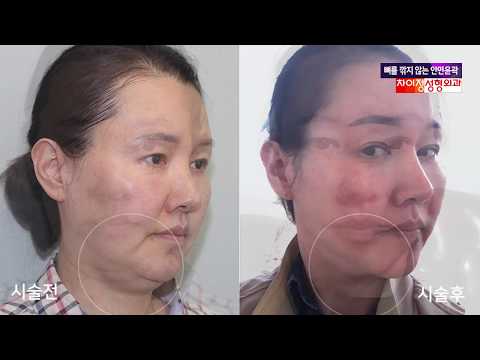 50대 중년여성 처진얼굴 리프팅-턱살&턱밑지방흡입으로 리프팅 일자별 정리