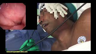 Sleep Endoscopy(D.I.S.E.) Prior To Snoring & Sleep Apnea Surgery-The Science Explained 2 (Subtitled)