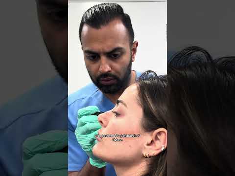 Nose Filler Gone Wrong? Ultrasound Shows Migration! #nosefiller