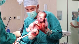 🐣🐣 Live #caesarean birth of twins. Watch the father’s face 😅