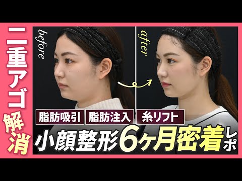 【小顔整形】「ダイエットや脂肪溶解注射をしても無くならない」二重アゴと笑った時の頬の膨らみを解消【顔の脂肪吸引・糸リフト・脂肪注入】