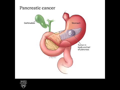 Mayo Clinic Minute - Detecting pancreatic cancer