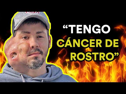 VIVIR CON CÁNCER DE ROSTRO (Entrevista a Sebastián Amurín)