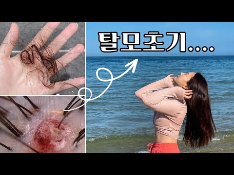 머리숱이 이렇게 많은데 내가 탈모라니... 탈모로 산다는건! 내돈내산 탈모관리 방법