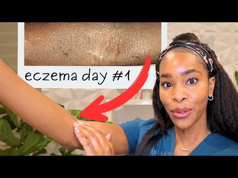 12 Life Changing Tips For Eczema: From a Derm with Eczema