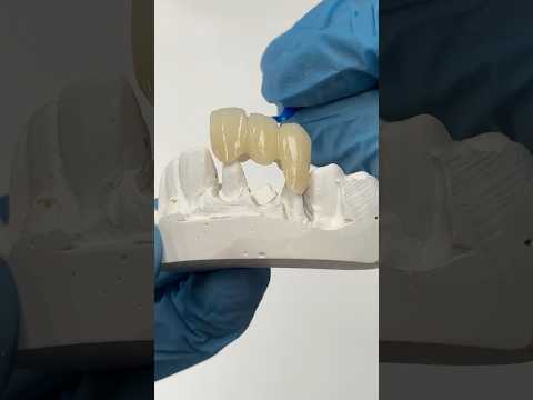 Temporary PMMA Bridge #lsk121shorts #dentist #teeth