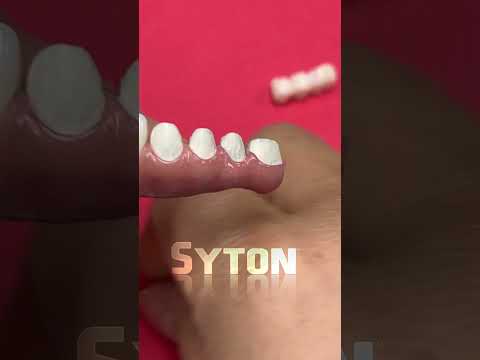 Individual crowns on metal framework - SYTON