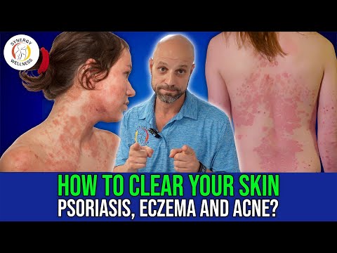 How To Clear Your Skin  Eczema, Psoriasis, Acne?