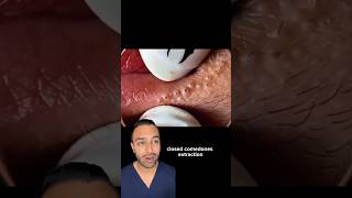 Your lip balm might be causing this! Blackheads removal | Dr Somji reacts