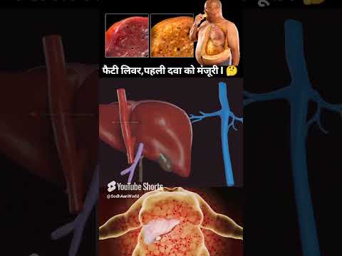 Fatty liver, first medicine approved, फैटी लिवर,पहली दवा को मंजूरी I #ytshorts #fettyliver #medicine