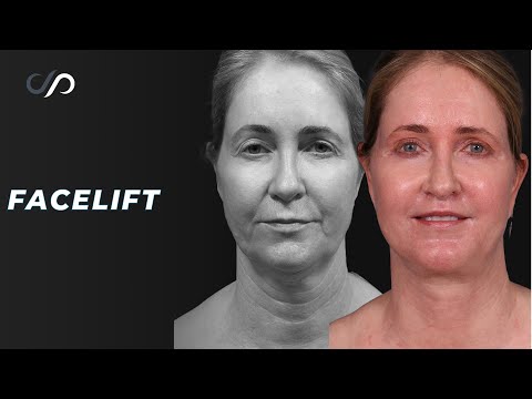 Traceless Face and Neck Lift TRANSFORMATION Surgery | Dr. Stoker