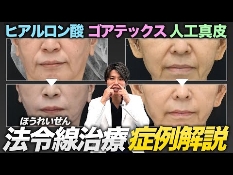 【ほうれい線治療の症例一挙公開】「ヒアルロン酸でも治らない…」ほうれい線難民必見！ほうれい線基部の窪み改善法を詳細解説【ゴアテックス・人工真皮】