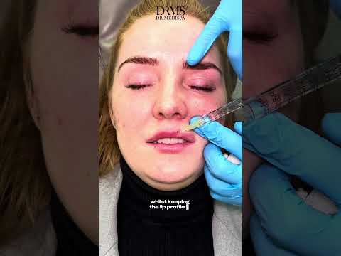 Instant Lip Filler Transformation - DrMedispa