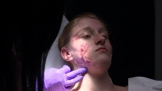 Hope for Teen Suffering from Hidradenitis Suppurativa?