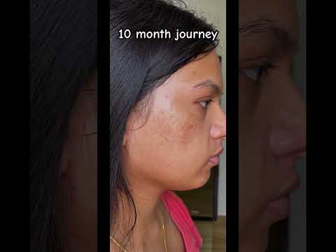 My acne journey || Hormonal acne || Transformation | #shorts #acne #transformation #journey #viral