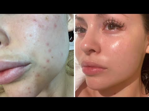 My Skincare Journey + How-To Clear Your Skin Fast  | Jadeywadey180