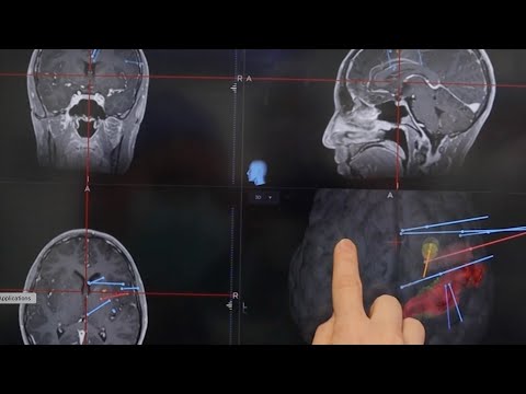 Mayo Clinic Minute - Looking for clues to stop seizures