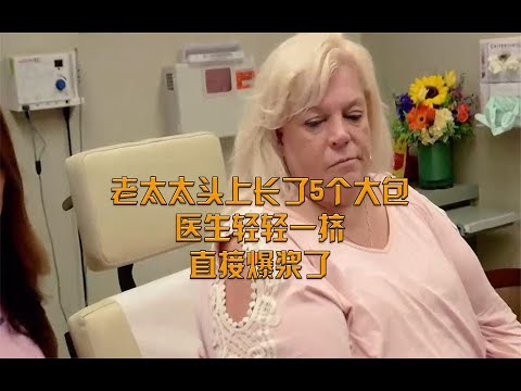 【挤痘大师】老太太头上长了5个大包，医生轻轻一挤，直接爆浆了